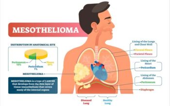 Malignant Pleural Mesothelioma Treatment