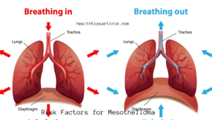 Risk Factors for Mesothelioma: Your Risk If Affected