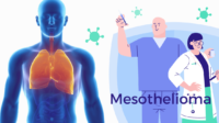 Signs of Mesothelioma: How Can I Prevent It From Killing Me?